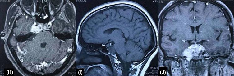 Figure 37.4, Fifteen months later, follow-up MRI depicted a recurrent tumor in the right petroclival junction, petrous apex, and cavernous sinus (H, preop axial; I, preop sagittal; J, preop coronal).