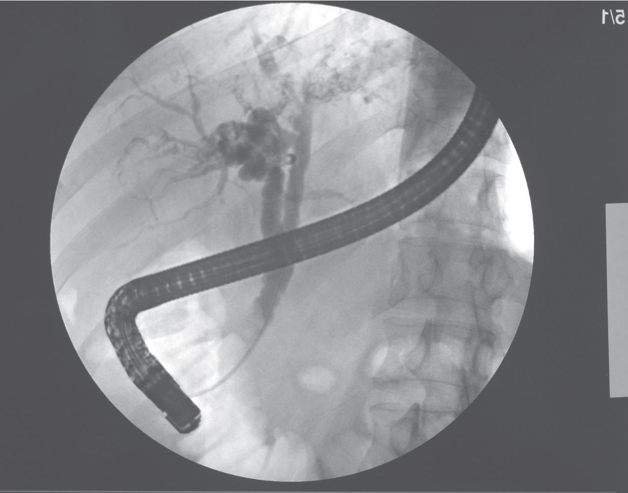 FIGURE 44.3, Endoscopic retrograde cholangiopancreatography showed focal dilatation of intrahepatic ducts with stone accumulation inside the intrahepatic ducts.