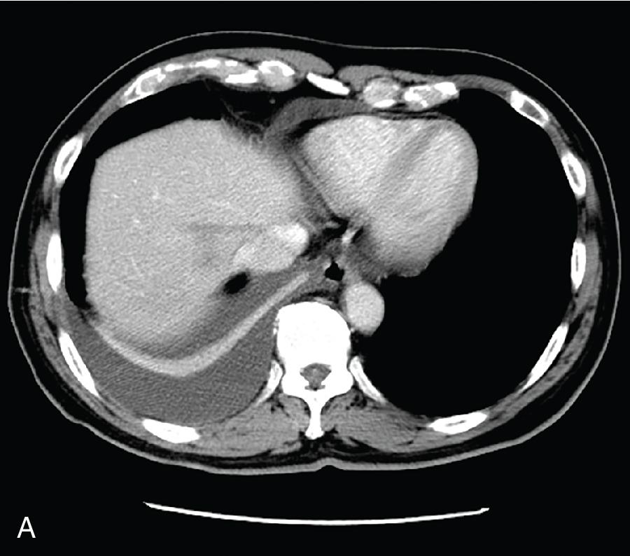 FIGURE 44.6, A, Patient who presented with recurrent pyogenic cholangitis (RPC) with recurrent infection and abscess formation in the dome of the liver, resulting in pleural effusion. B, Patient presented with RPC, with strictures in the intrahepatic portion of S8 ducts and the left duct was not well shown in endoscopic retrograde cholangiopancreatography due to stone impaction. Right hepatectomy is warranted in view of the focal stricture in the intrahepatic duct. Percutaneous transhepatic biliary drainage was inserted to the S8 duct before liver resection to control the systemic sepsis (see Chapter 30 ).