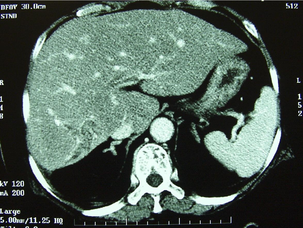 FIGURE 44.7, A, Computed tomography scan showed atrophy of the right posterior sector of the liver with stone impaction of the right sectorial duct. Recurrent infection with ductal stricture resulted in the atrophy of the local segment of liver (see Chapter 16 ). B, Operative photo of right posterior sectionectomy for an atrophic liver, secondary to recurrent pyogenic cholangitis. The right anterior section of the liver has undergone hypertrophic changes. C, Right posterior section of liver is atrophic, with stricture at the origin of the duct and multiple stones impacted inside the diseased duct.
