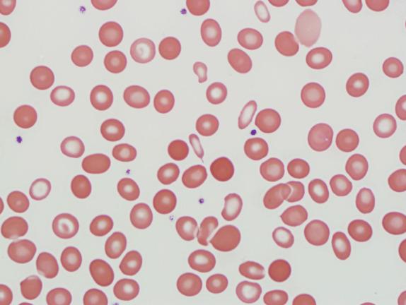 FIG. 1.11, Acquired sideroblastic anemia (myelodysplastic syndrome with ring sideroblasts), peripheral blood findings. Dimorphic red blood cells include a normocytic, normochromic population and a distinct microcytic, hypochromic subset.