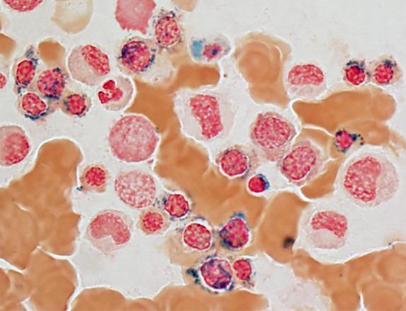 FIG. 1.12, Acquired sideroblastic anemia (myelodysplastic syndrome with ring sideroblasts), marrow aspirate smear iron stain findings. Ring sideroblasts seen in some myelodysplastic syndromes are highly associated with mutations in protein constituents of the RNA spliceosome; the underlying genetic abnormalities found in congenital sideroblastic anemia are different, but the morphologic findings are similar.