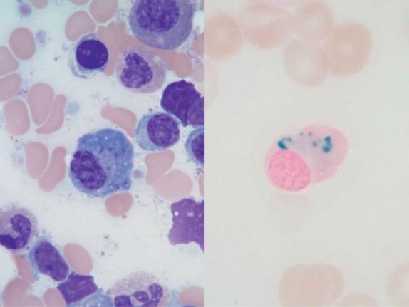 FIG. 1.13, Hemosiderin in plasma cells appears blue to greenish black with Wright-Giemsa stain (left) and can be confirmed with the Prussian blue stain (right). This finding has been commonly associated with copper deficiency but can also be observed in some other conditions related to iron overload.