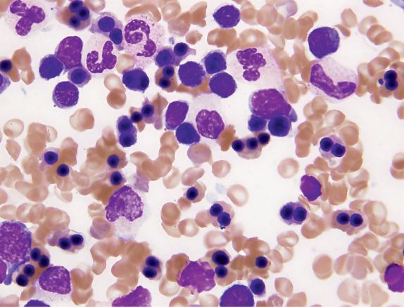 FIG. 1.14, Congenital dyserythropoietic anemia type II, bone marrow aspirate smear findings. Binucleation of the erythroid precursors is characteristic and is often restricted to the late polychromatophilic or orthochromatophilic erythroblasts.