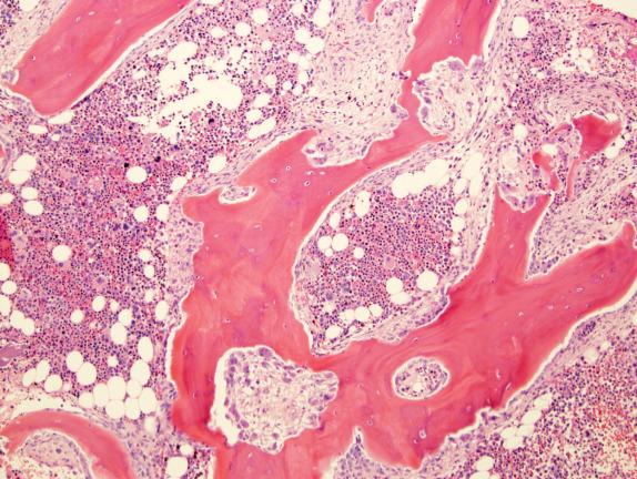 FIG. 1.15, Renal osteodystrophy, bone marrow biopsy findings. The bone in this marrow biopsy specimen from a patient with renal osteodystrophy demonstrates an irregular erosive lesion with fibrosis, prominent osteoblastic rimming, and osteoid deposition.