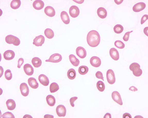 FIG. 1.2, Megaloblastic anemia, peripheral blood findings. This blood smear from a patient with severe megaloblastic anemia demonstrates prominent anisopoikilocytosis, including large oval cells (oval macrocytes), microcytes, and teardrop cells.
