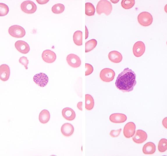 FIG. 1.3, Megaloblastic anemia, peripheral blood findings. Coarse basophilic stippling (left) and circulating nucleated red cells (right) are common in megaloblastic anemia. The red cell precursor is relatively mature, judging by the pink-gray quality of the cytoplasm. However, the chromatin is quite open, with an abnormal stippled appearance, indicating megaloblastic change.