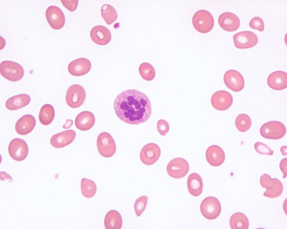 FIG. 1.4, Megaloblastic anemia, peripheral blood findings. A hypersegmented neutrophil in the peripheral blood of a patient with megaloblastic anemia. Neutrophils are generally considered hypersegmented when they contain six or more lobes.