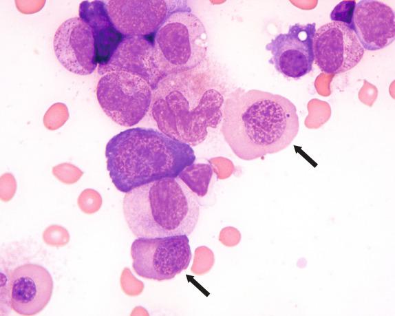 FIG. 1.5, Megaloblastic anemia, bone marrow aspirate smear findings. This marrow aspirate smear image from a patient with severe megaloblastic anemia demonstrates two late-stage erythroid precursors (based on an advanced degree of cytoplasmic hemoglobinization) that are abnormally large and have dispersed, stippled megaloblastic chromatin (arrows). Also present is a giant granulocyte at approximately the metamyelocyte stage with abnormally dispersed chromatin (immediately to the left of upper arrowed megaloblast).