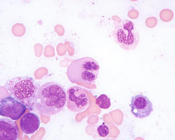 FIG. 1.6, Megaloblastic anemia, bone marrow aspirate smear findings. This image demonstrates a dysplastic-appearing orthochromic erythroid precursor with two nuclei and irregularly distributed chromatin.