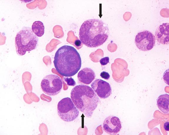 FIG. 1.7, Megaloblastic anemia, bone marrow aspirate smear findings. This marrow aspirate from the same patient as in Fig. 1.6 demonstrates two giant bands with abnormally dispersed megaloblastic chromatin. Note that these cells (arrows) are larger than the early basophilic normoblast in the field and other granulocytes in the field.