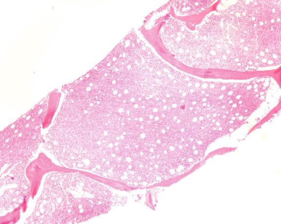 FIG. 1.8, Megaloblastic anemia, bone marrow biopsy findings. The bone marrow biopsy in megaloblastic anemia is hypercellular.