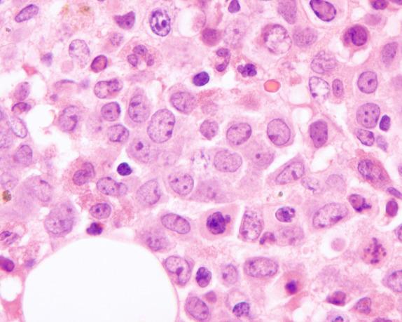 FIG. 1.9, Megaloblastic anemia, bone marrow biopsy findings. Prominent proliferations of immature erythroid precursors with fine chromatin and distinct nucleoli can be mistaken easily for acute leukemia or large cell lymphoma in biopsy sections.