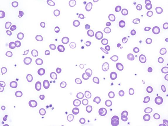 FIG. 1.10, Iron deficiency anemia, peripheral blood findings. In this smear from a patient with severe iron deficiency, there is variation in size and shape of the red cells (anisopoikilocytosis). The red cells are obviously hypochromic, with an enlarged area of central pallor and relatively little remaining hemoglobin. An elongate elliptocyte (pencil cell) is visible slightly to the right and above the center of the field. These poikilocytes are characteristic but nonspecific features of iron deficiency anemia.