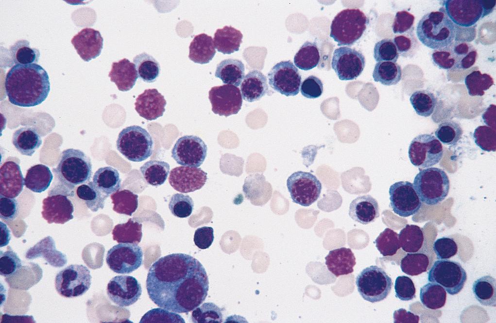 Figure 14.1, Marrow aspirate smear from a patient with hemolytic anemia. There is an increased number of maturing erythroid progenitors (normoblasts).