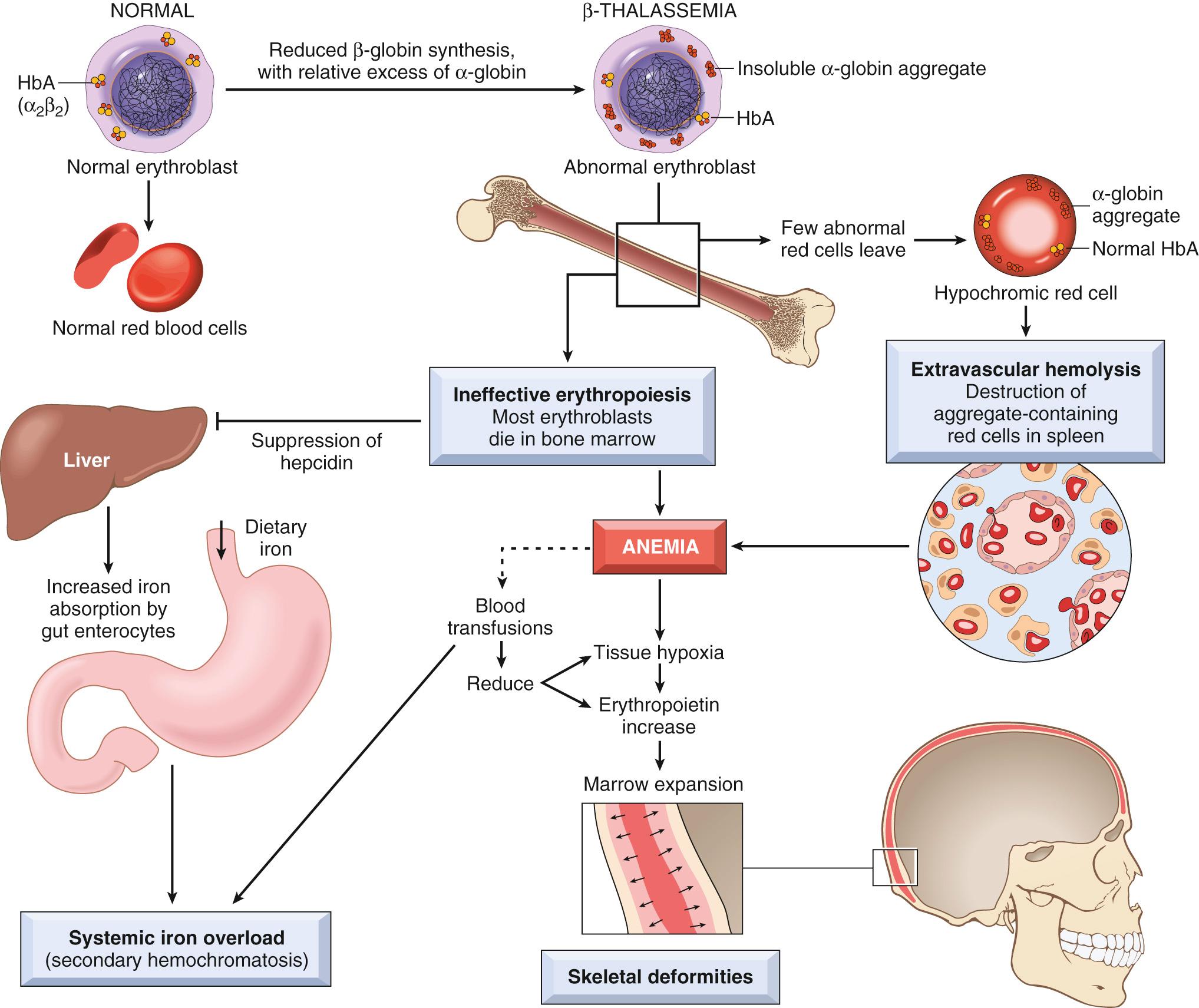 Figure 14.11, Pathogenesis of β-thalassemia major. Note that the aggregates of unpaired α-globin chains, a hallmark of the disease, are not visible in routinely stained blood smears. Blood transfusions are a double-edged sword, diminishing the anemia and its attendant complications, but also adding to the systemic iron overload. HbA, Hemoglobin A.