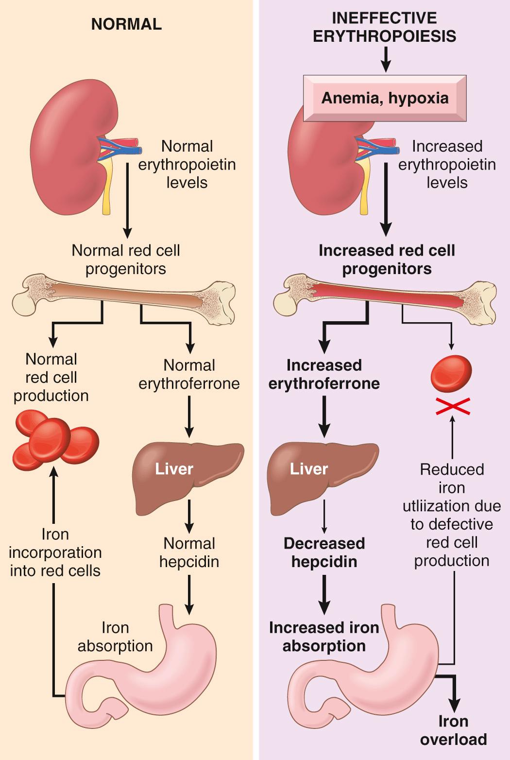 Figure 14.12, Mechanism of iron overload due to ineffective hematopoiesis. In the setting of ineffective erythropoiesis, such as in those with severed thalassemia, increased release of erythroferrone from the expanded mass of erythroid progenitors suppresses hepcidin production, leading to increased iron uptake from the gut.