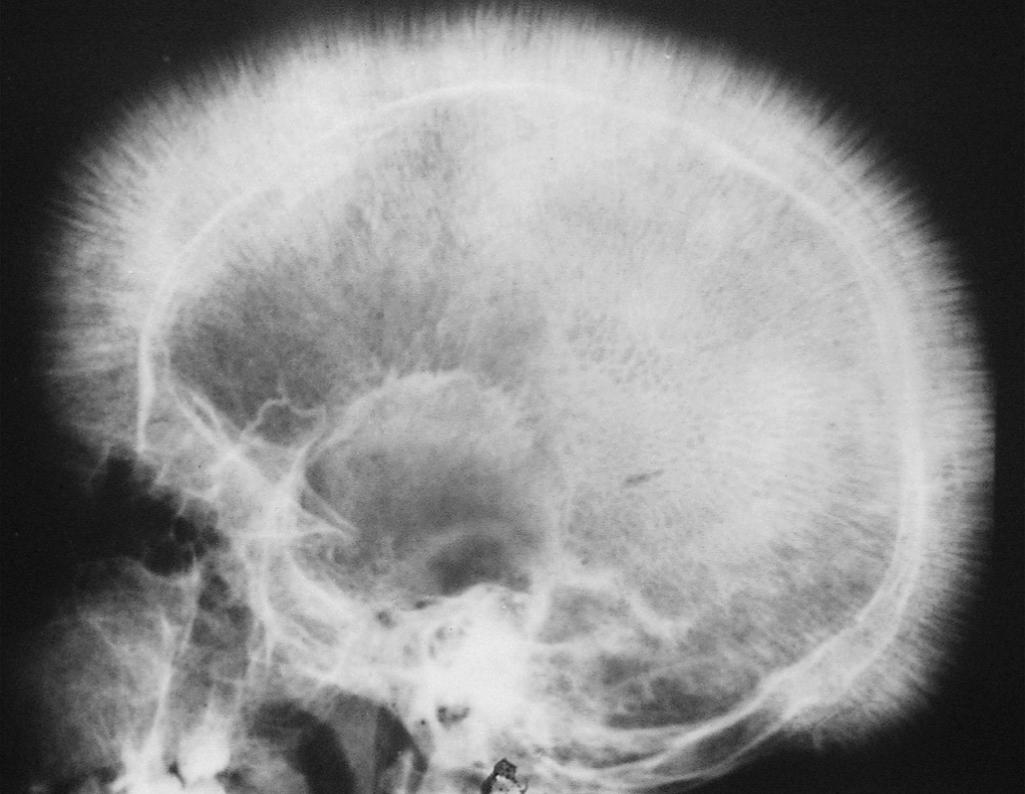 Figure 14.13, β-Thalassemia major. X-ray film of the skull showing new bone formation on the outer table, producing perpendicular radiations resembling a crewcut.