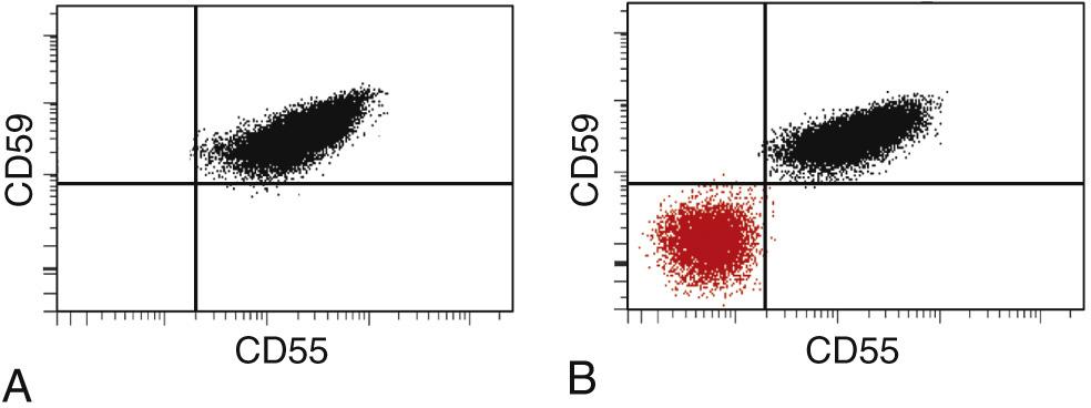 Figure 14.14, Paroxysmal nocturnal hemoglobinuria (PNH). (A) Flow cytogram of blood from a normal individual shows that the red cells express two phosphatidylinositol glycan (PIG)-linked membrane proteins, CD55 and CD59, on their surfaces. (B) Flow cytogram of blood from a patient with PNH shows a population of red cells that is deficient in both CD55 and CD59. As is typical of PNH, a second population of CD55+/CD59+ red cells that is derived from residual normal hematopoietic stem cells also is present.