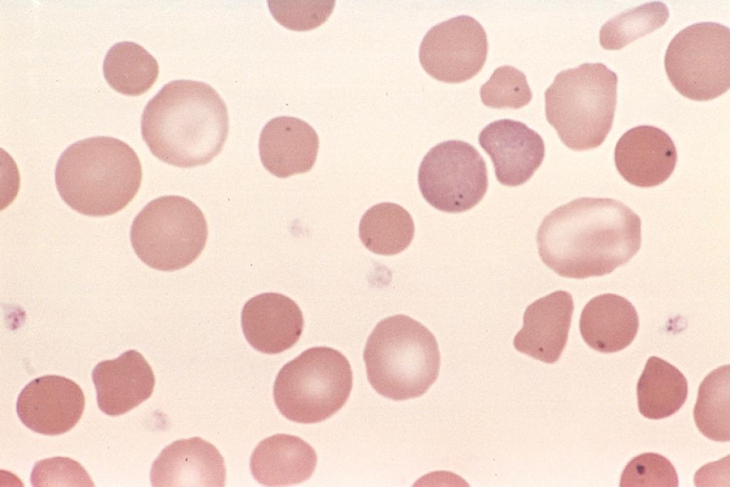 Figure 14.4, Hereditary spherocytosis (peripheral smear). Note the anisocytosis and several dark-appearing spherocytes with no central pallor. Howell-Jolly bodies (small, dark nuclear remnants) also are seen in some of the red cells of this asplenic patient.