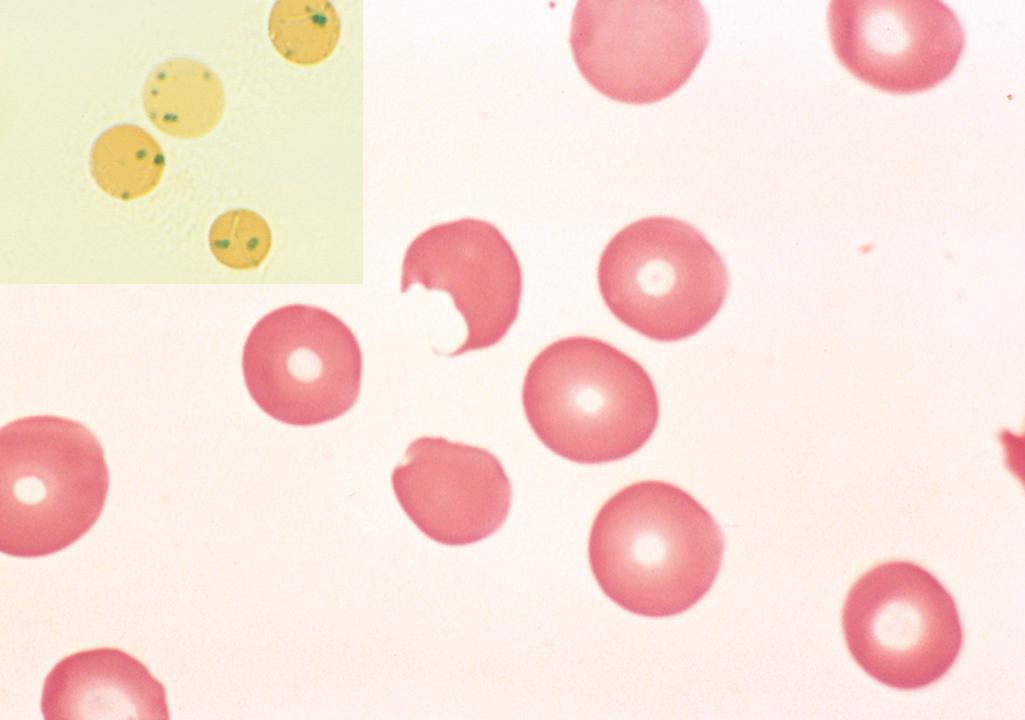 Figure 14.6, Glucose-6-phosphate dehydrogenase deficiency: effects of oxidant drug exposure (peripheral blood smear). Inset, Red cells with precipitates of denatured globin (Heinz bodies) revealed by supravital staining. As the splenic macrophages pluck out these inclusions, “bite cells” like the one in this smear are produced.