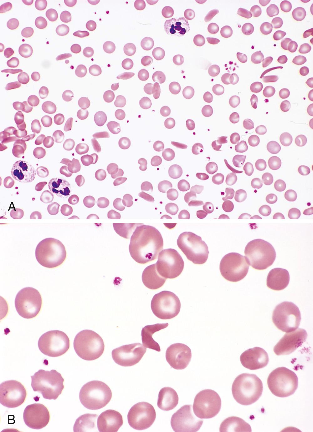 Figure 14.8, Sickle cell disease (peripheral blood smear). (A) Low magnification shows irreversibly sickled cells as well as target cells and red cell anisocytosis and poikilocytosis. (B) Higher magnification shows an irreversibly sickled cell in the center.