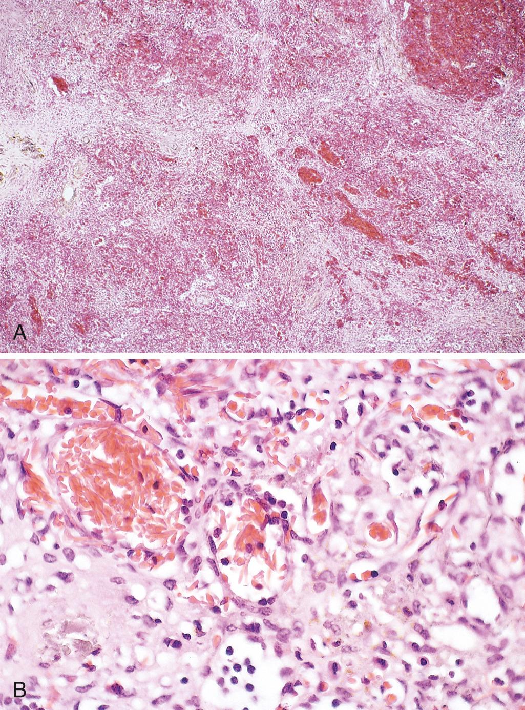 Figure 14.9, (A) Spleen in sickle cell disease (low power). Red pulp cords and sinusoids are markedly congested; between the congested areas, pale areas of fibrosis resulting from ischemic damage are evident. (B) Under high power, splenic sinusoids are dilated and filled with sickled red cells.