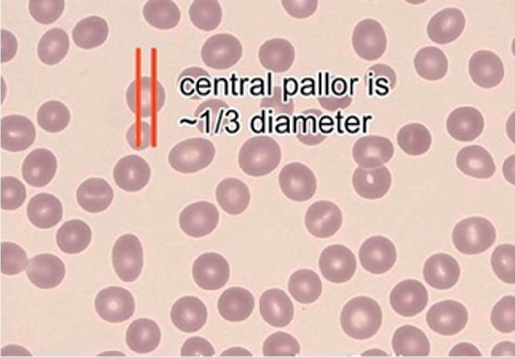 FIGURE 76.1, Normal red blood cell morphology.