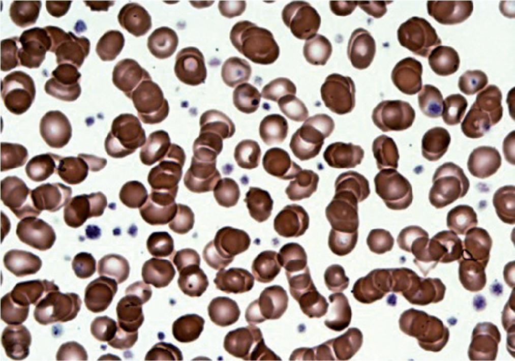 FIGURE 76.9, Red cell aggregates (rouleaux and red blood cell agglutinates).