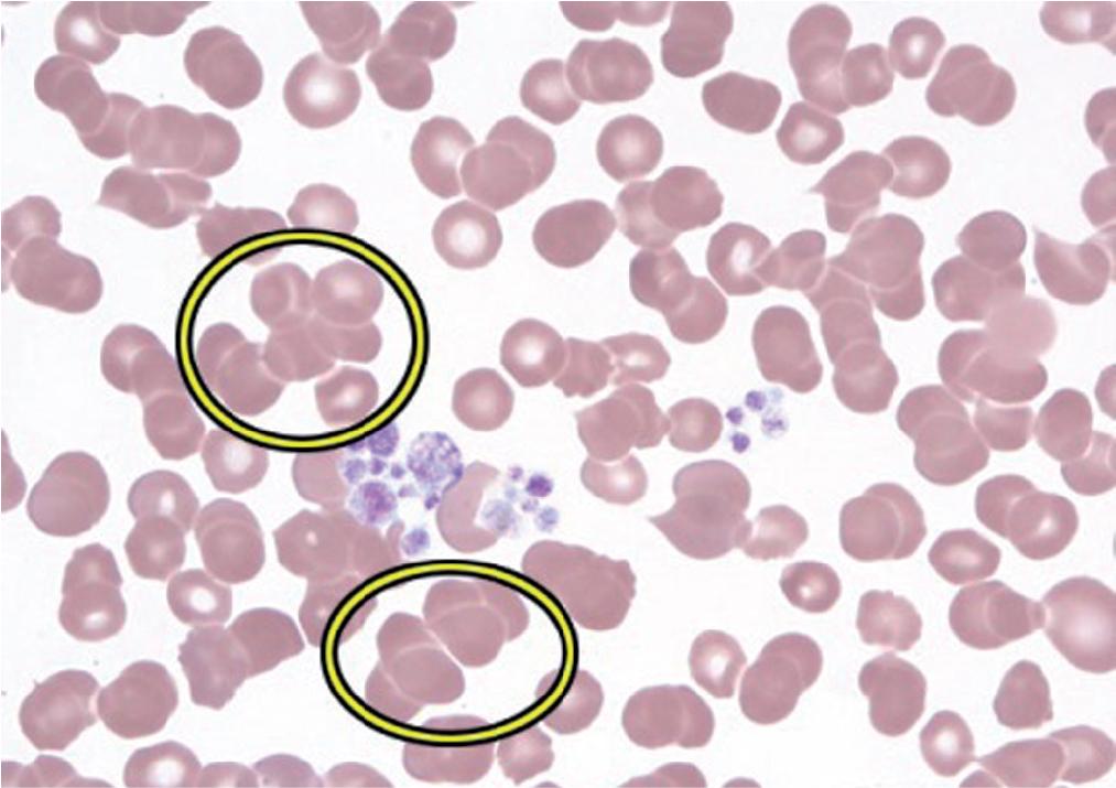 FIGURE 76.10, Red cell aggregates (red blood cell agglutinates indicated by circles ).