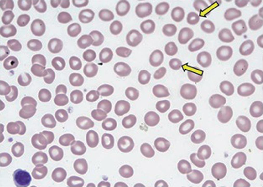 FIGURE 76.2, Microcytic red blood cells (indicated by arrows ).