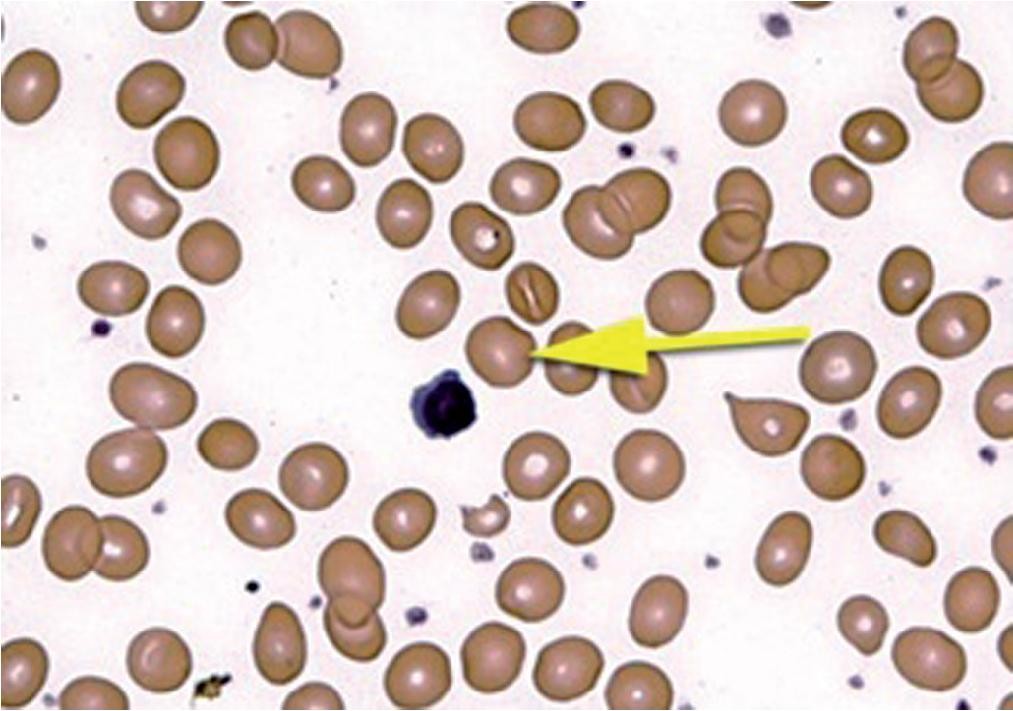 FIGURE 76.3, Macrocytic red blood cells (arrows).