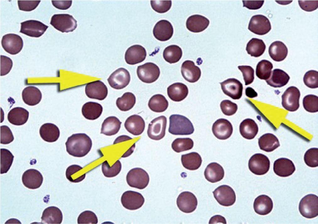 FIGURE 76.5, Target cells (typical target cells indicated by arrows ).