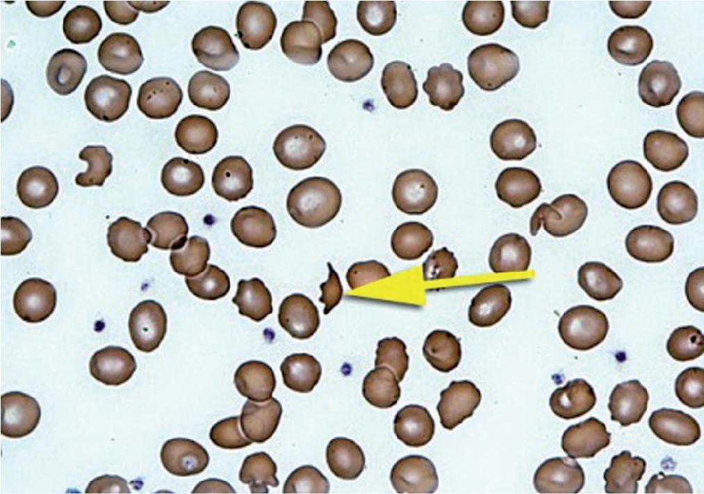 FIGURE 76.6, Schistocytes (typical schistocyte fragmented red cell is indicated by arrow ).