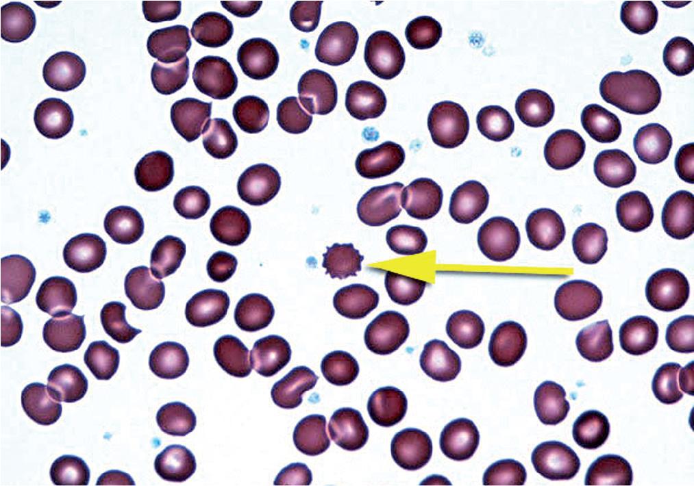 FIGURE 76.7, Echinocytes or burr cells (indicated by the arrow ).