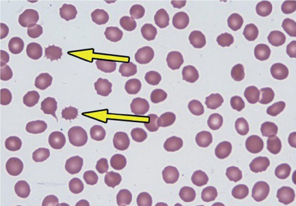 FIGURE 76.8, Acanthocytes (typical acanthocytes indicated by arrows ).