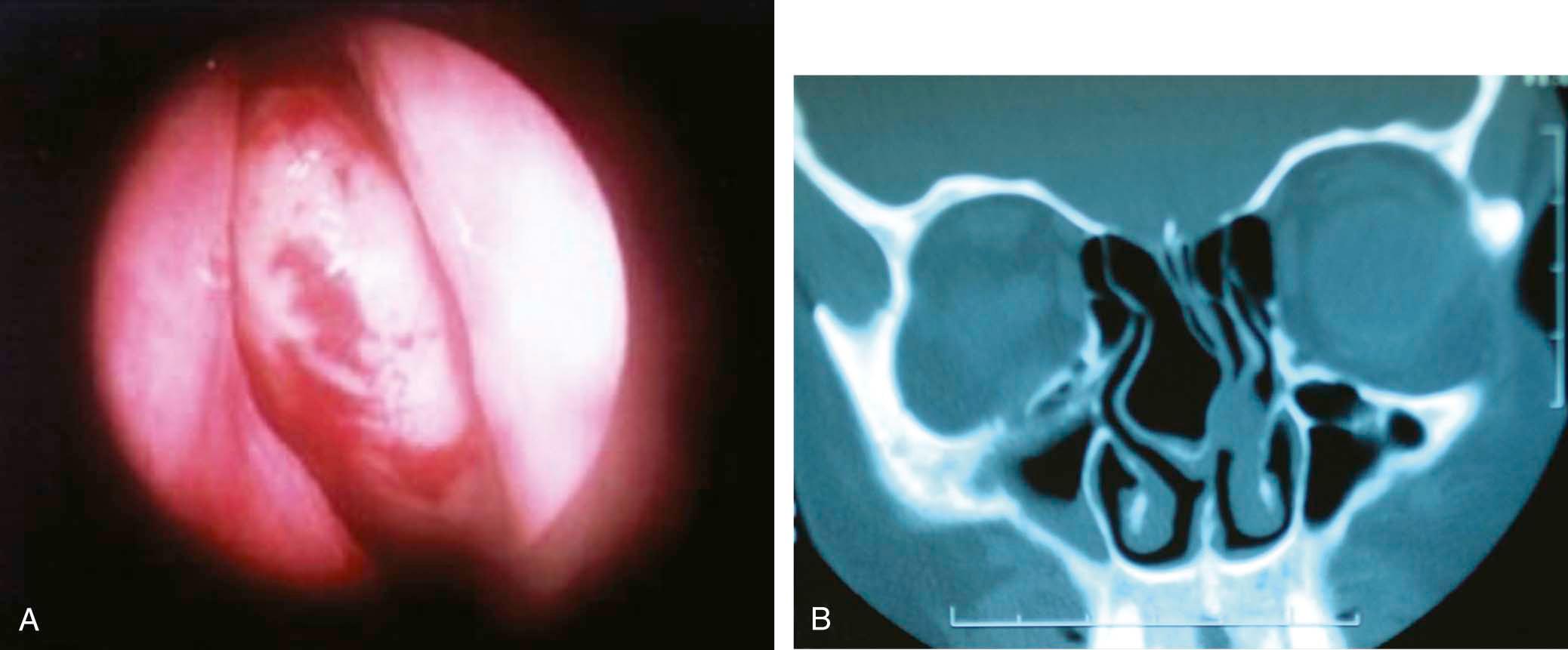 Figure 9-2, A patient seeking revision rhinoplasty had persisting nasal obstruction despite a history of prior septoplasty at the time of her rhinoplasty. Endoscopic examination was suggestive of a large concha bullosa ( A ). CT scan was confirmatory ( B ).