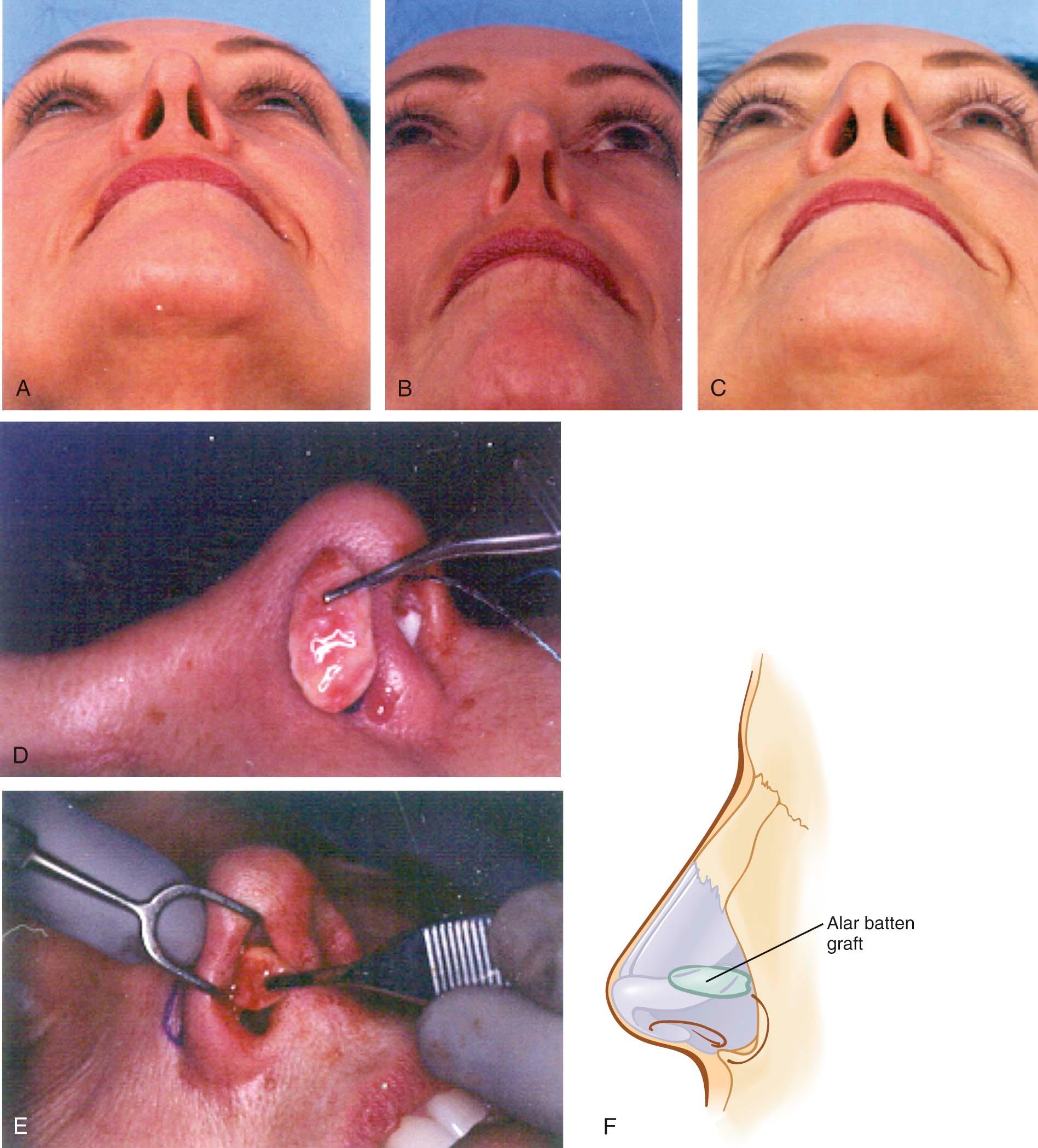 Figure 9-3, Nasal valve collapse may be apparent on normal inspiration, as seen here. Alar batten grafts may be placed via an external rhinoplasty approach, or into a precise pocket made through an endonasal incision as shown here. This graft is nonanatomic and is typically placed caudal to the lateral crura where there is maximal collapse of the lateral nasal wall and supra-alar pinching. If alar batten grafts are placed too far cephalic, excessive fullness over the middle vault will be noted. Patients should be told that there will be temporary fullness in the area of the graft. This fullness will typically decrease over 2 to 3 months. For maximal support, the alar batten graft should extend over the bone of the pyriform aperture. A, Preoperative; B, preoperative with normal inspiration; C, postoperative; D, E, intraoperative, endonasal approach; F, diagrammatic of alar batten graft.