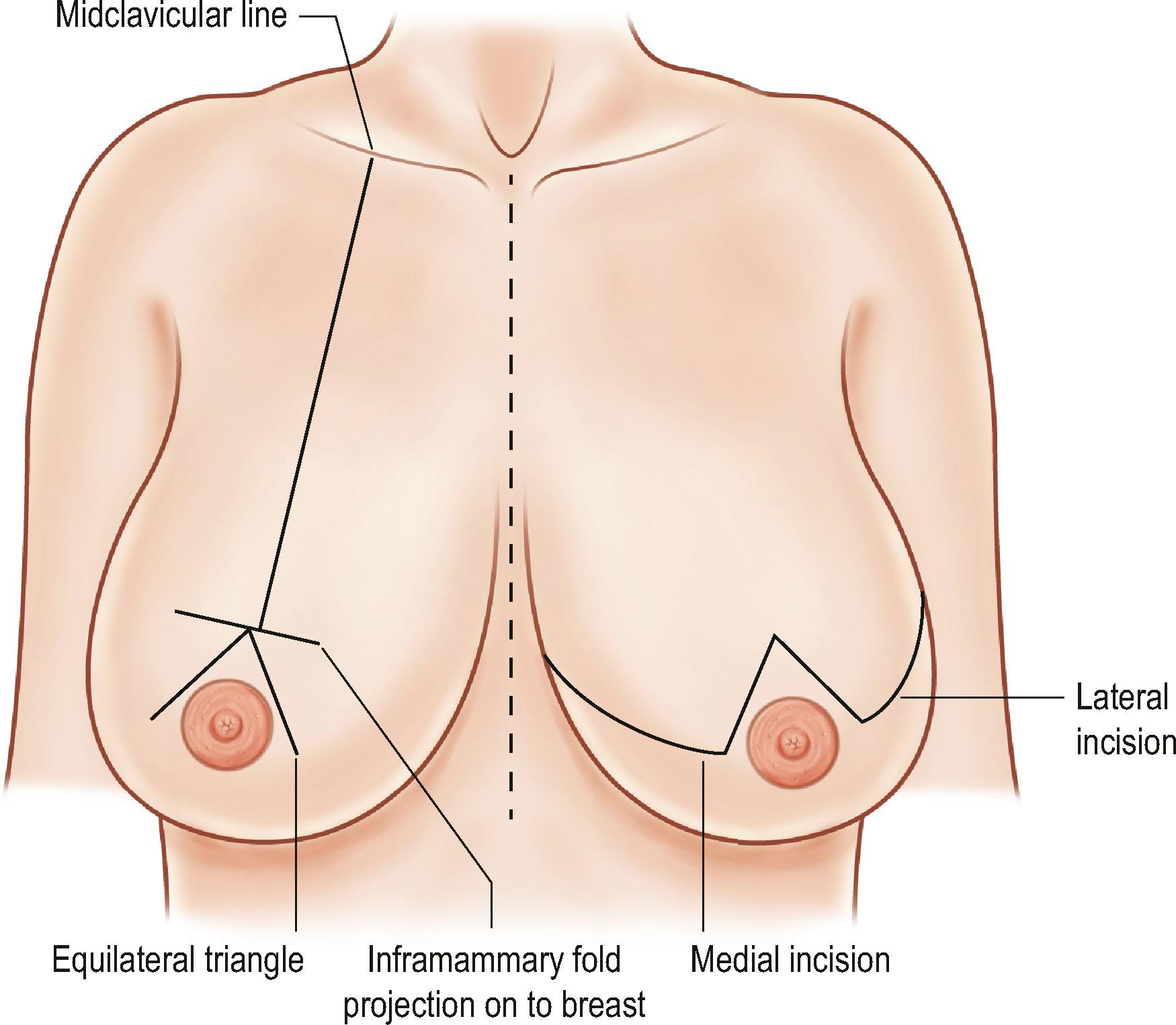 Figure 9.3, Patient preoperative marking. With the patient in an upright position, the midclavicular line is drawn. The nipple location is determined by a projection through the breast from the inframammary fold. This is marked at the bottom of the midclavicular line. Symmetry is confirmed by using a ruler to compare the distance of each midclavicular line from the midline.