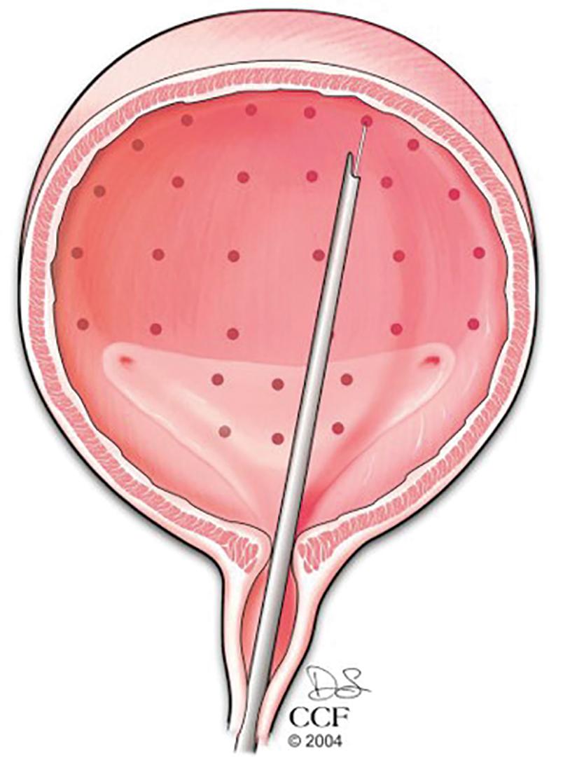 Fig. 32.1, Injection pattern for onabotulinum toxin A.