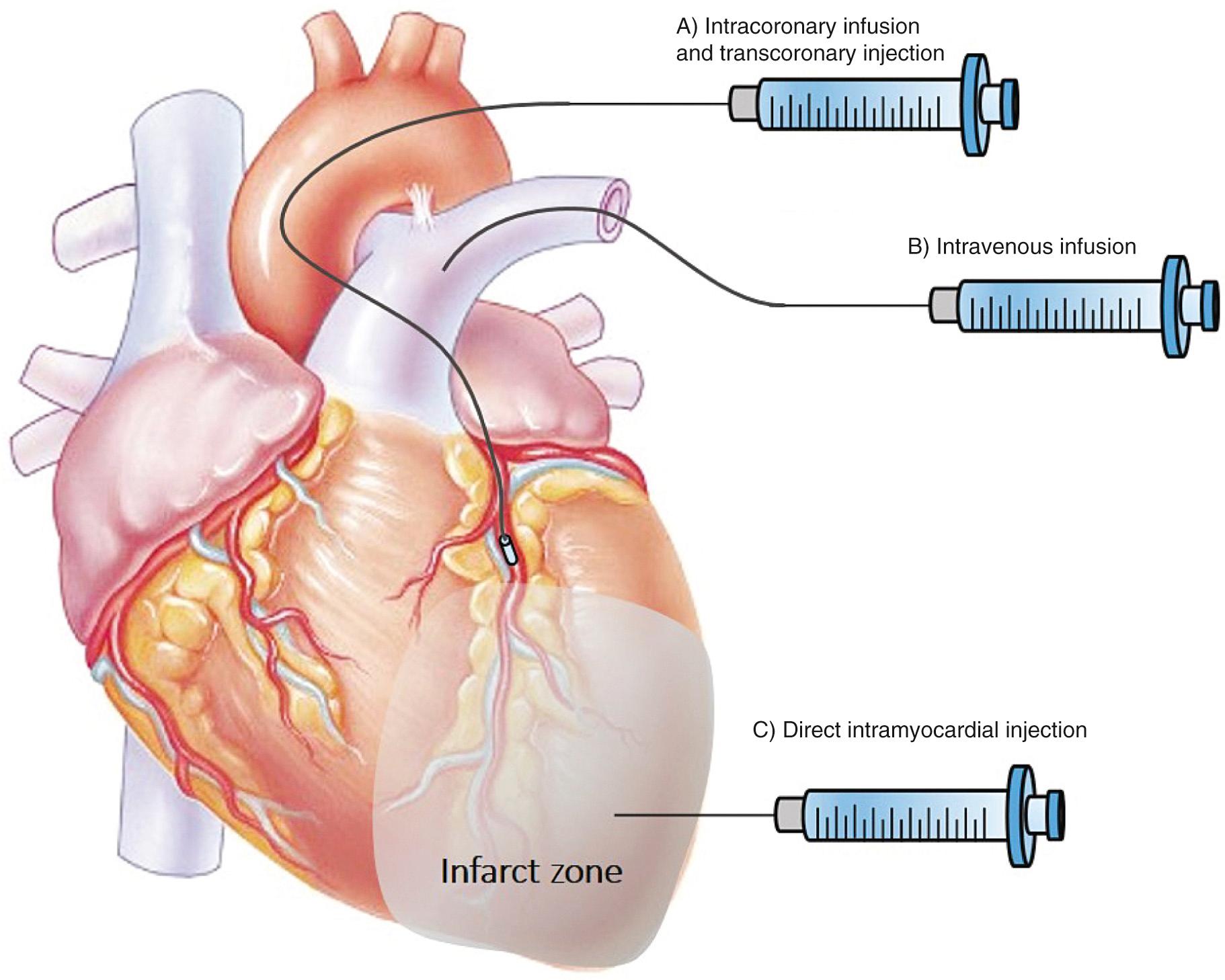 FIGURE 101-1, Delivery routes for transplanted cells for the treatment of ischemic heart disease.