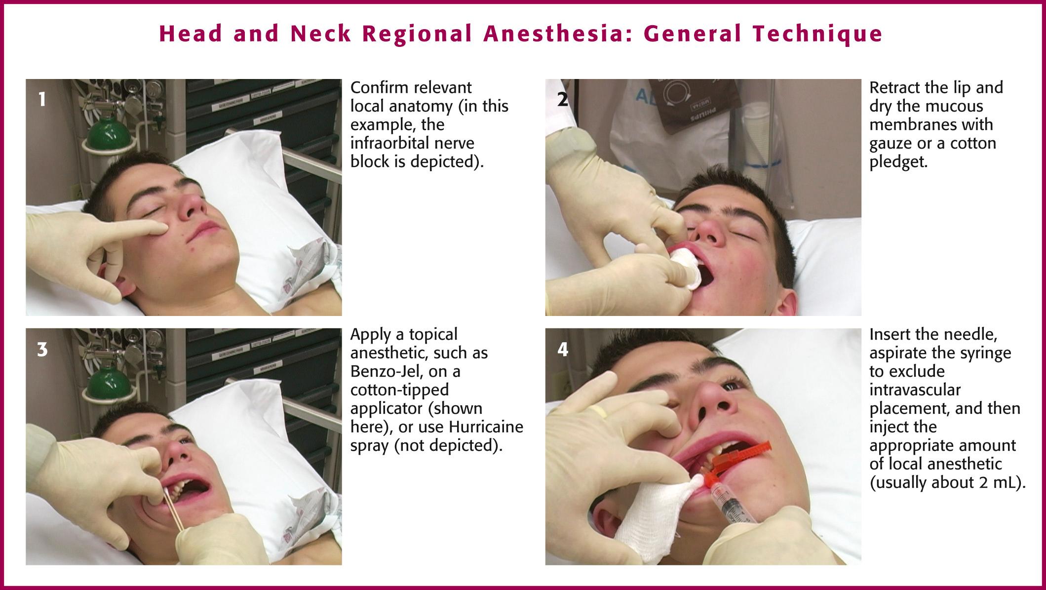 Figure 30.2, Head and neck regional anesthesia: general technique depicting the infraorbital nerve block.