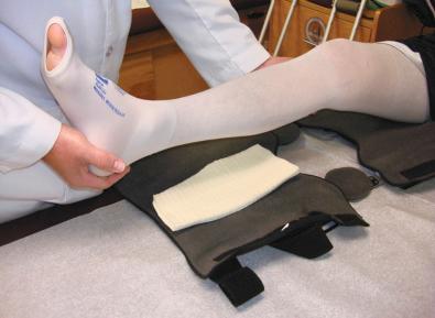 FIG 18-7, Knee extension brace with posterior calf pad to maintain tibiofemoral reduction.