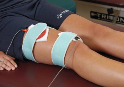 FIG 11-1, Electrical muscle stimulation is used to facilitate and enhance an adequate quadriceps contraction early postoperatively.