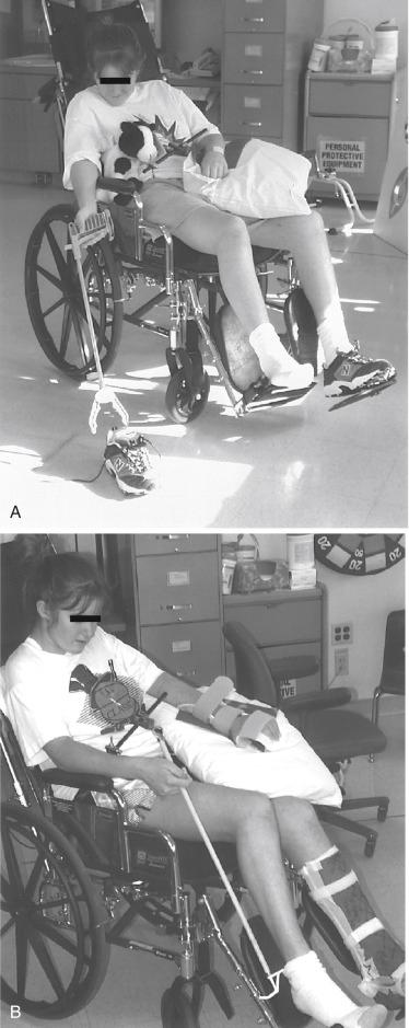 Fig. 22.1, This 17-year-old driver sustained multiple injuries in a motor vehicle crash, including pelvic and sacral fractures and traumatic brain injury resulting in left hemiparesis. She remained non-weight-bearing in bilateral lower extremities until the time of discharge from early rehabilitation and had significant motor impairment in her left upper extremity because of the neurologic injury. Provision of adaptive equipment, including a reacher (A) and sock aid (B), reduced caregiver assistance required in self-care.