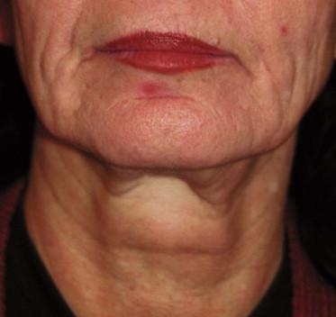 FIGURE 41.2, Aged neck displaying poor skin quality.