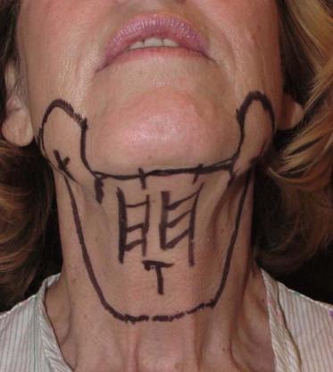 FIGURE 41.4, Preoperative patient markings.