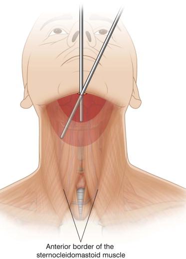 FIGURE 41.6, The path of neck liposuctioning. The lateral borders of the sternocleidomastoid muscles of the neck define the area of neck suctioning.