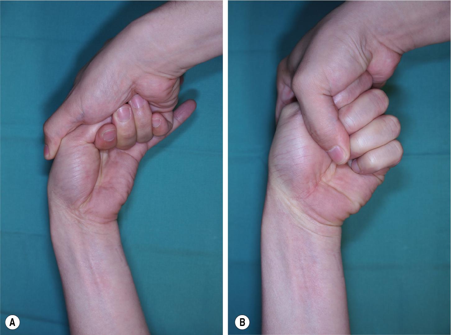 FIGURE 84.2, (A–B) EPB entrapment test. EPB, Extensor pollicis brevis.