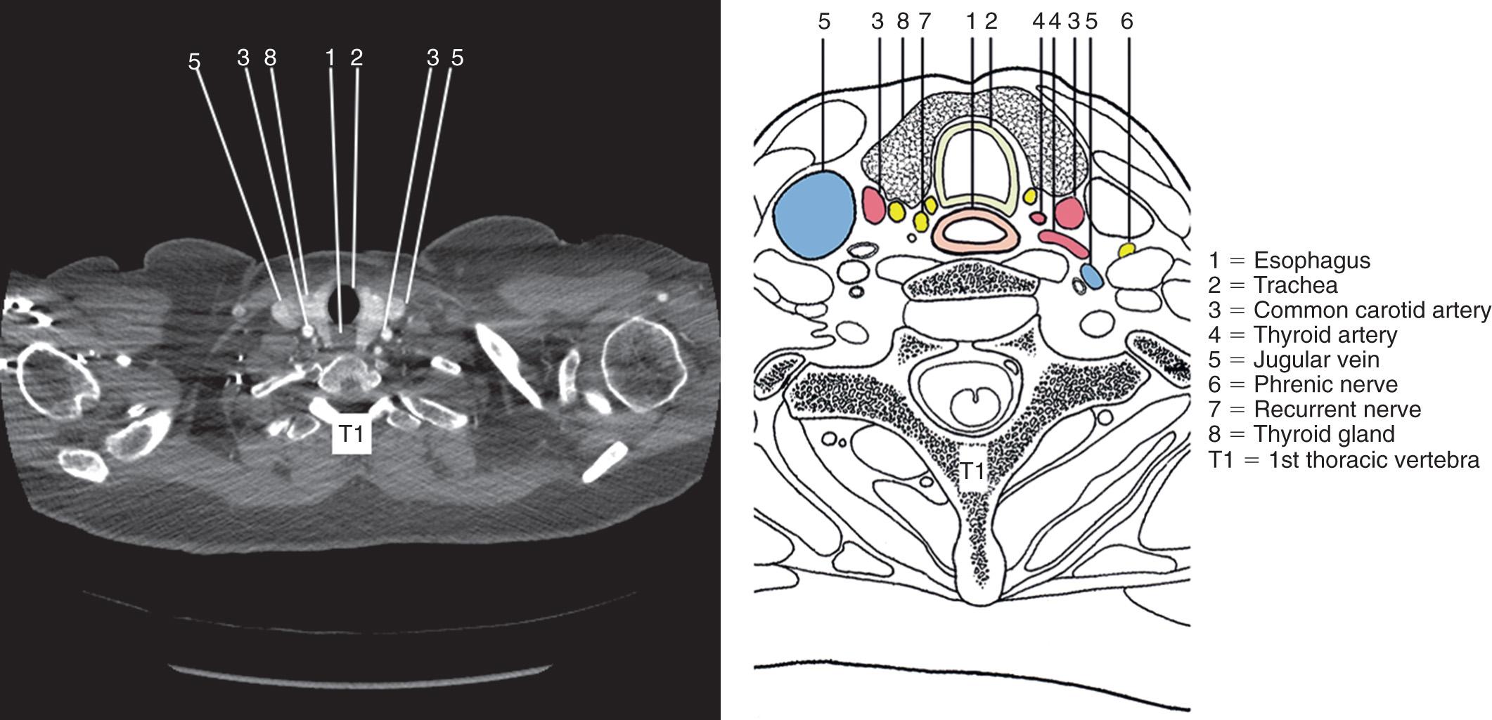 FIGURE 4.7, Topographic anatomy of the cervical esophagus at the level of the thyroid gland with a corresponding computed tomography image.